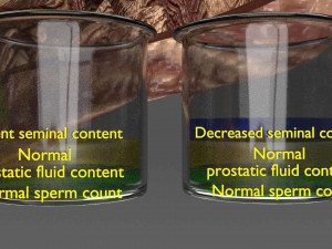 Seminal fluid according to cause of azoospermia 3D 模型