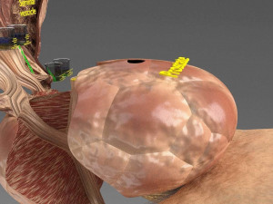 Seminal fluid according to cause of azoospermia 3D 模型