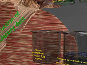 Seminal fluid according to cause of azoospermia 3D 模型