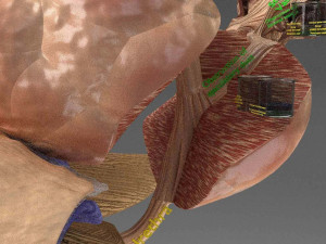 Seminal fluid according to cause of azoospermia 3D 模型