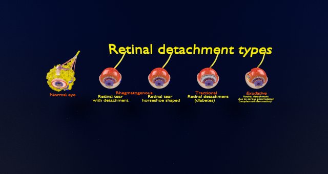 Retinal detachment types eye Modelo 3D .c4d .max .obj .3ds .fbx .stl .blend 