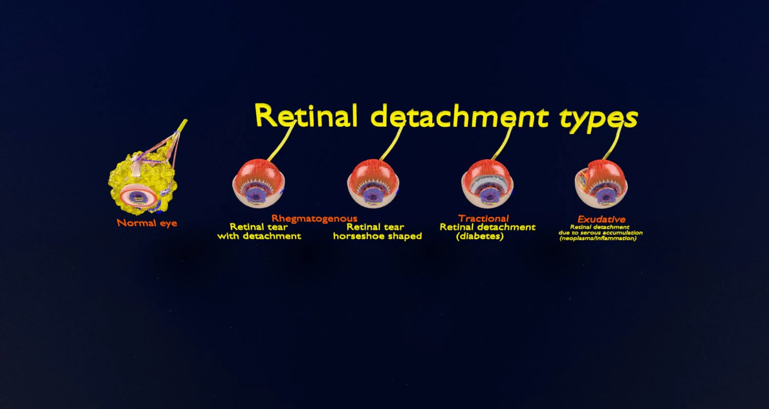 Retinal detachment types eye 3D Model .c4d .max .obj .3ds .fbx .stl .blend