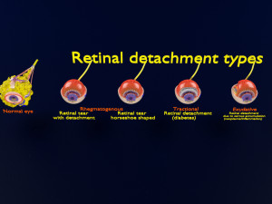 Retinal detachment types eye 3Dモデル