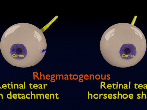 Retinal detachment types eye Modelo 3D