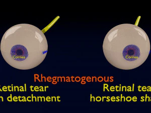Retinal detachment types eye 3D Model