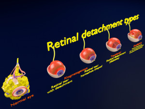 Retinal detachment types eye Modelo 3D