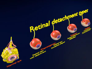 Retinal detachment types eye 3D Model