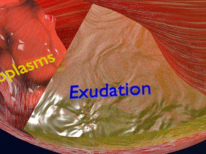 Retinal detachment types eye 3D Model