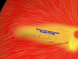 Retinal detachment types eye 3D Model