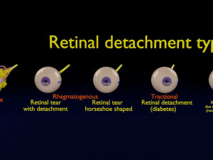 Retinal detachment types eye Modelo 3D
