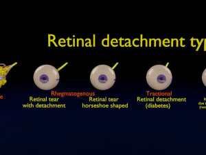 Retinal detachment types eye 3D Model