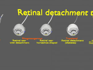 Retinal detachment types eye 3D Model