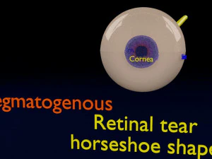 Retinal detachment types eye 3D Model