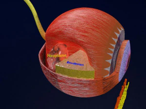 Retinal detachment types eye 3D Model