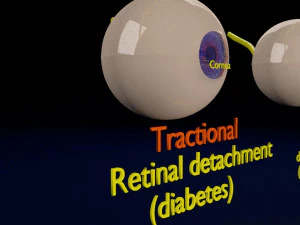 Retinal detachment types eye 3D Model