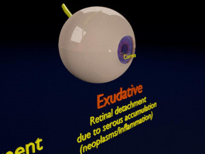 Retinal detachment types eye Modelo 3D