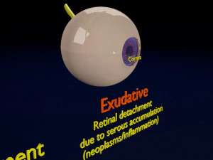 Retinal detachment types eye 3D Model