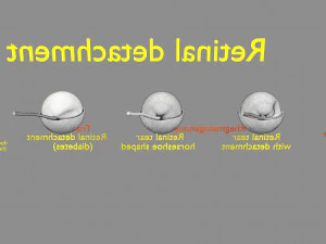 Retinal detachment types eye 3D Model