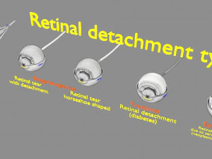 Retinal detachment types eye 3D Model