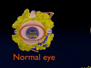 Retinal detachment types eye Modelo 3D