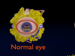 Retinal detachment types eye 3D Model