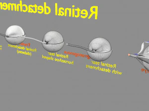 Retinal detachment types eye 3D Model