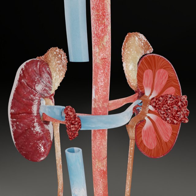 Renal cell carcinoma Modelo 3D .c4d .max .obj .3ds .fbx .stl .blend 