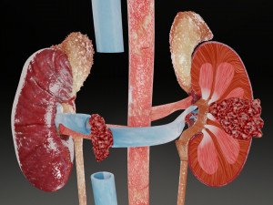 Renal cell carcinoma 3D मॉडल