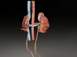 Renal cell carcinoma Modelo 3D
