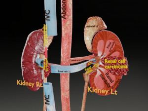 Renal cell carcinoma Modelo 3D