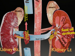 Renal cell carcinoma Modelo 3D