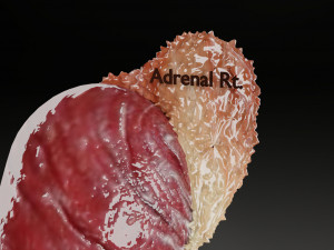 Renal cell carcinoma Modelo 3D