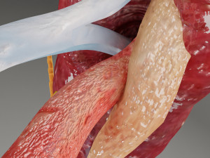 Renal cell carcinoma Modelo 3D