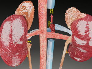 Renal cell carcinoma Modelo 3D