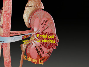 Renal cell carcinoma Modelo 3D