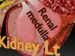 Renal cell carcinoma Modelo 3D