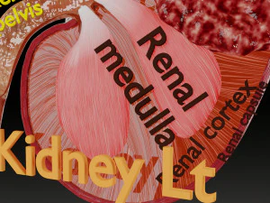 Renal cell carcinoma 3D Model