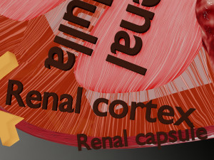 Renal cell carcinoma Modelo 3D