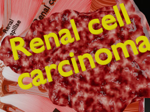 Renal cell carcinoma Modelo 3D