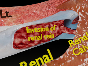 Renal cell carcinoma Modelo 3D