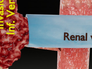 Renal cell carcinoma Modelo 3D