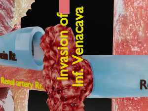 Renal cell carcinoma Modelo 3D