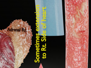 Renal cell carcinoma Modelo 3D