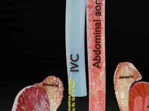 Renal cell carcinoma 3D Model