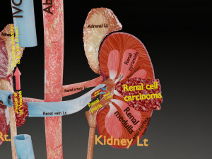 Renal cell carcinoma Modelo 3D