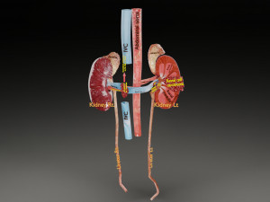 Renal cell carcinoma Modelo 3D