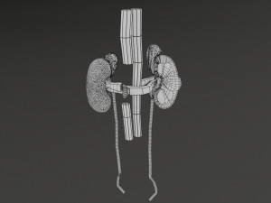 Renal cell carcinoma Modelo 3D