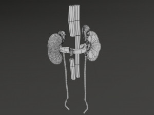 Renal cell carcinoma Modelo 3D