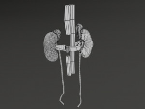 Renal cell carcinoma Modelo 3D