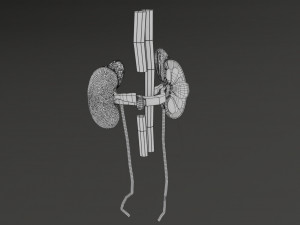 Renal cell carcinoma Modelo 3D